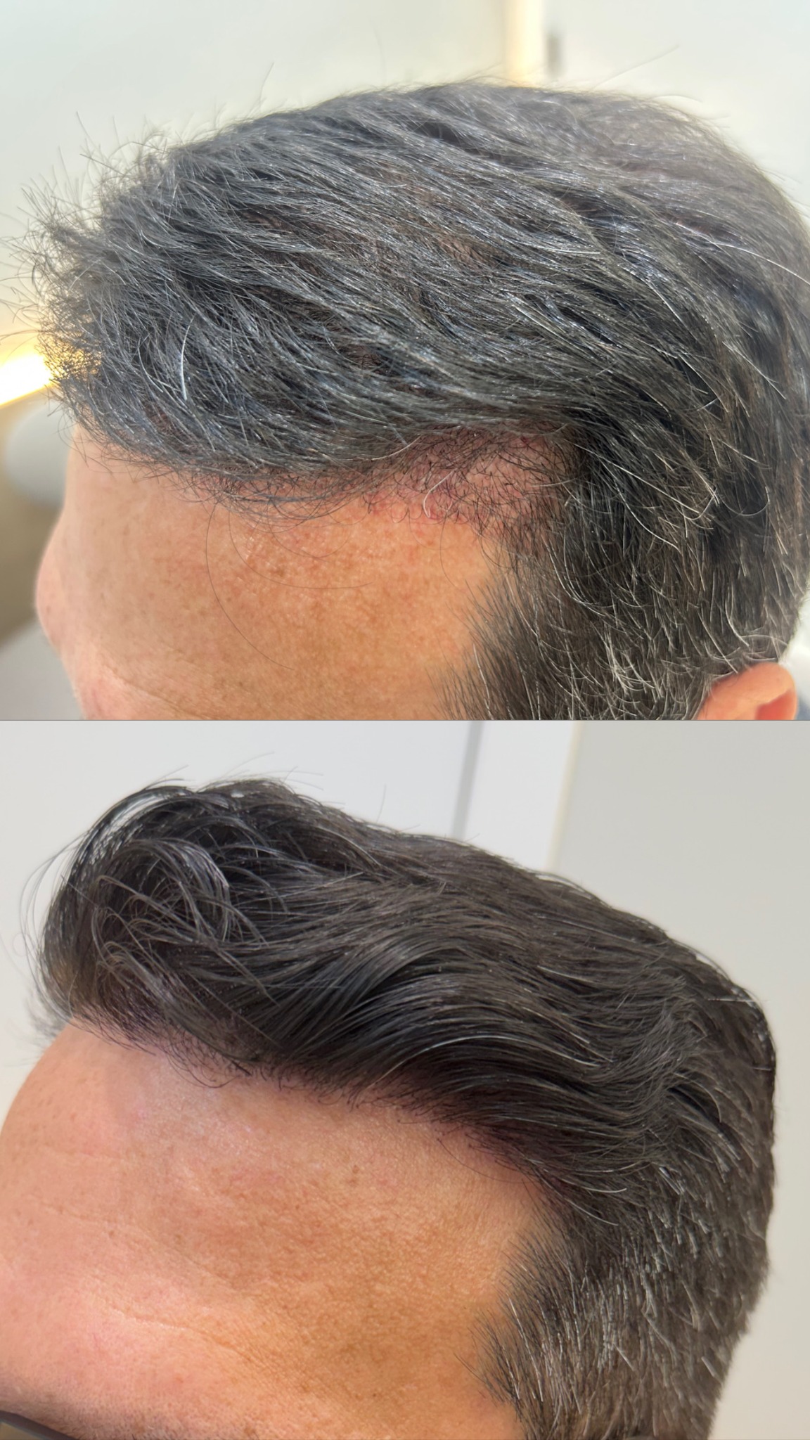 Resultado de transplante capilar com linha frontal natural