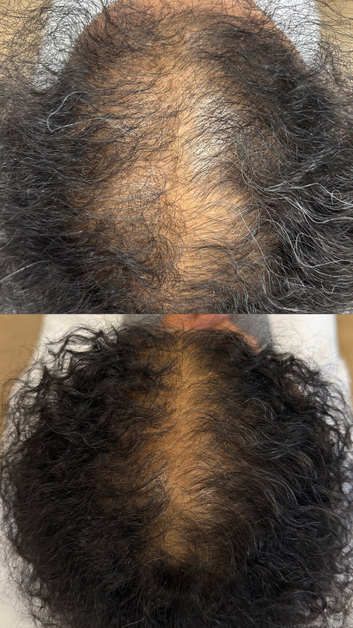 Comparativo antes e depois de evolução capilar durante tratamento clínico